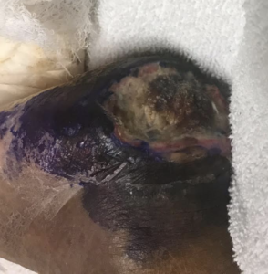 A close up photo of gangrene setting in the elderly woman's heel