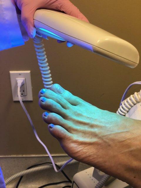 Nail Restoration - Corona Foot and Ankle