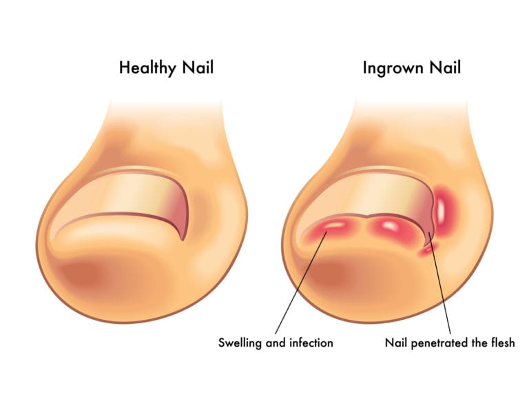 Nail fungus: Foothill Dermatology Medical Center: Dermatology