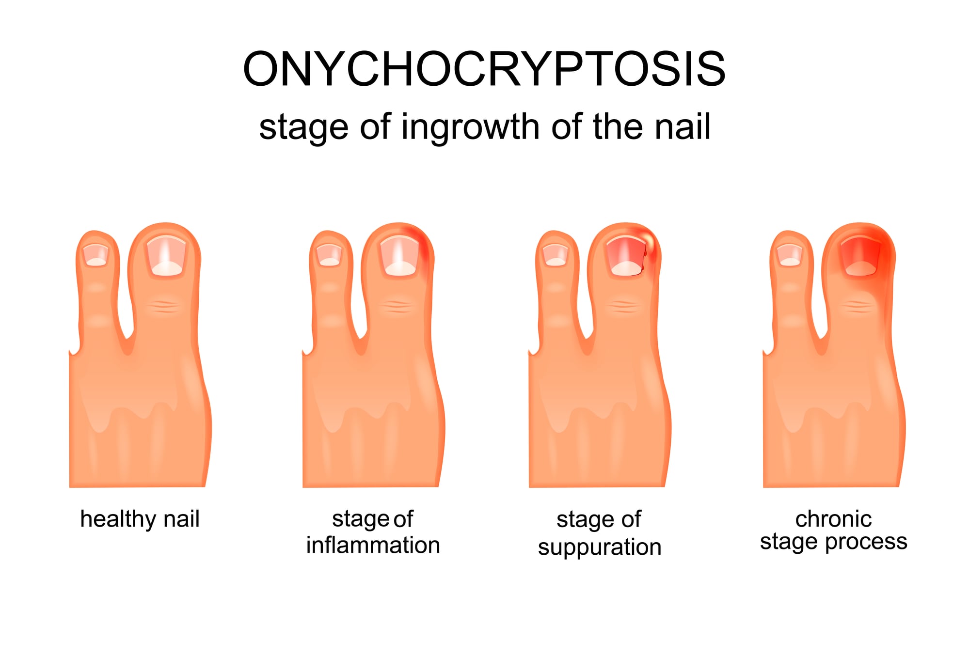 Ingrown toenails - Symptoms & causes - Mayo Clinic