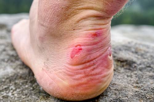 Caring for Diabetic Blisters