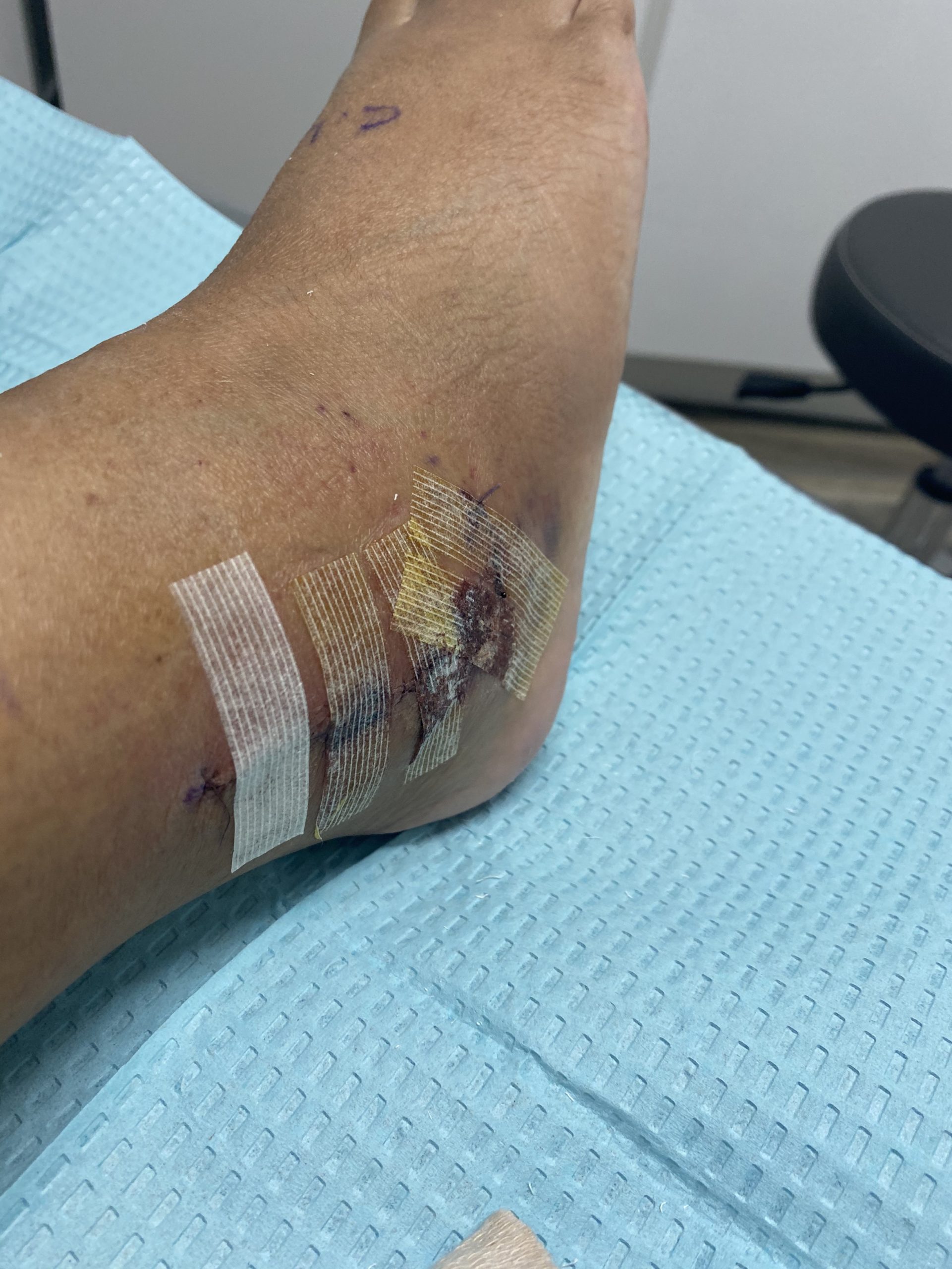 Foot with a wound. Diabetics with wounds need immediate attention. 